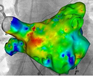 Dreidimensionale anatomische Rekonstruktion des linkes Vorhofes mit seinen vier Pulmonalvenen