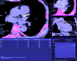 Kalk-Score Bestimmung