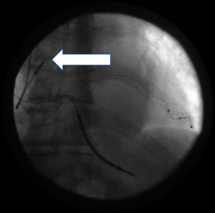 Abb.: Klassische Sondenpositionen eines CRT-D Systems