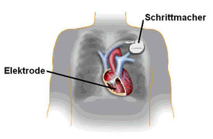 Schematische Darstellung: Weg der Elektroden