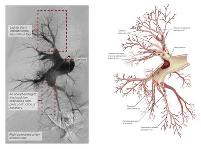 Pulmonalis-Angiographie