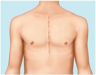 Konventionelle Sternotomie