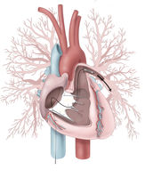 Zugang zur Lungenschlagader bei BPA