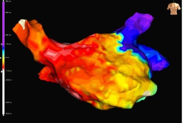 Dreidimensionale anatomische Rekonstruktion und Aktivierungsmap des linken Vorhofes und seinen vier Pulmonalvenen