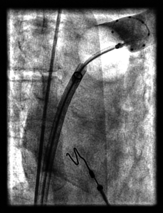 Kälteballon Ablation