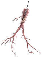 Drahtpassage bei BPA