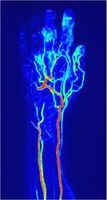 MR-Angiographie mit Verschlüssen der Fingergefäße