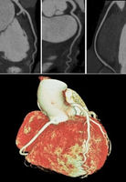 Computertomographie des Herzens